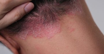 Wie bekommt man seborrhoische Dermatitis in den Griff? Ein Leitfaden zur Hautpflege