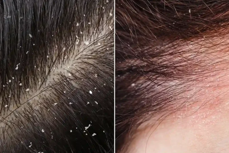 Lupy vs. suchá pokožka hlavy: Jak je rozeznat a co na ně funguje