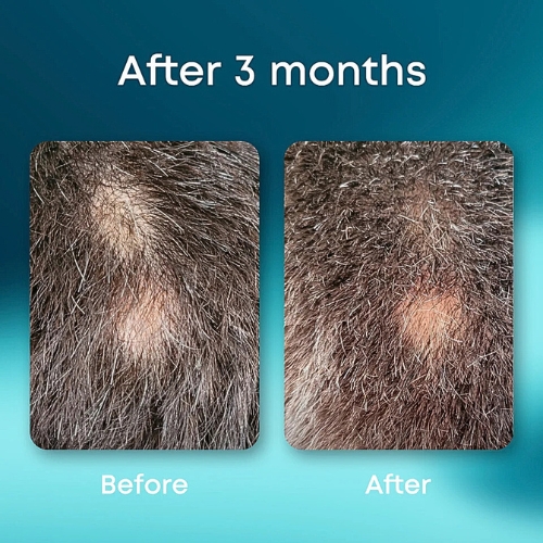 Sebomax HR Biotrade Hair Loss Gel Suitable for Beards 26ml