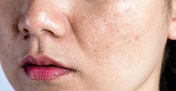 Pigmentflecken: Warum entstehen sie und wie wird man sie los?