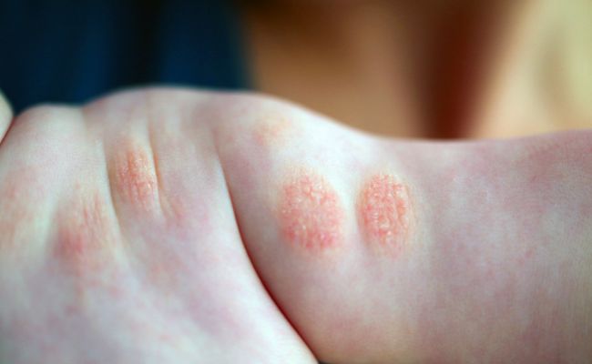 Atopic skin: A natural path to health