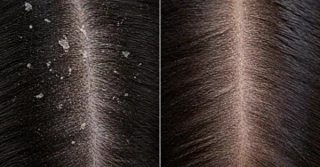Dandruff vs. dry scalp: How to tell the difference and what works