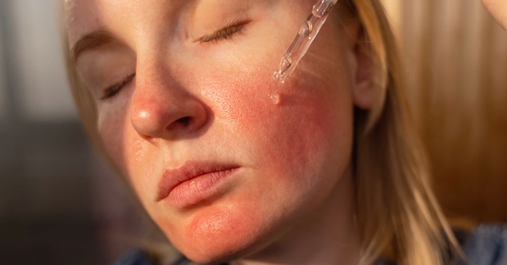 Citlivá pleť pod lupou: Fakty a mýty, ktoré by ste mali poznať