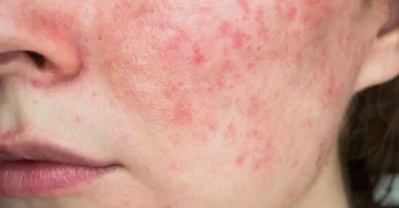 Rosacea: The Complete Skincare Routine