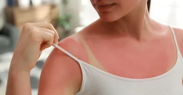 How to (not) get burned on holiday: The summer mistake we all make