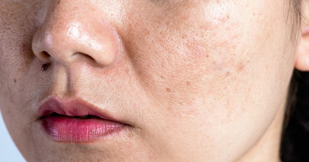 Pigment spots: Why do they occur and how can you get rid of them?