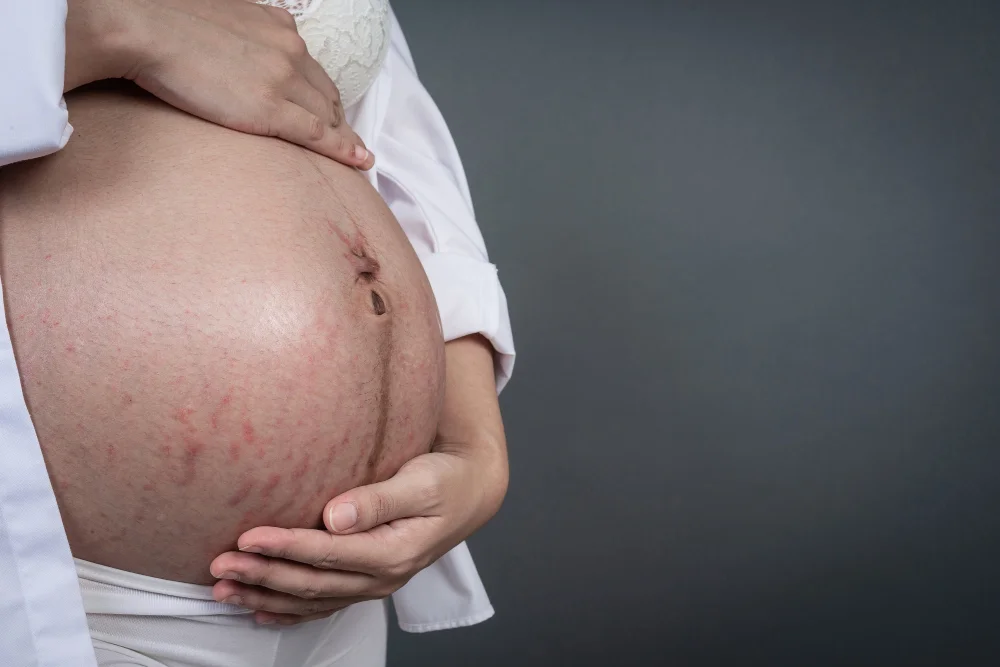 Stretch marks in pregnancy: what really works (and when to start), cream vs. oil + 2-minute daily routine
