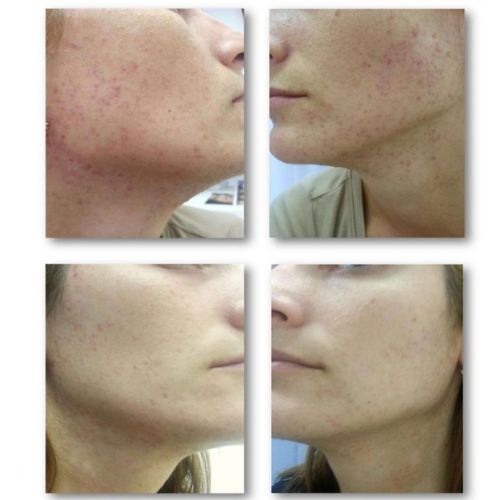 Zmatňujúce tonikum pre mastnú a problematickú pleť Acnaut Biotrade 60ml
