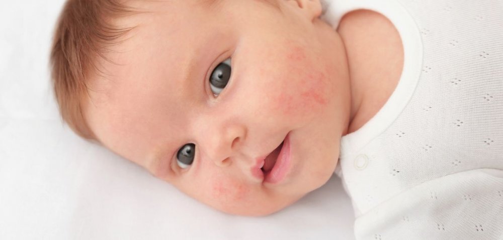 Nappy Rash: How to treat nappy rash, even in adults?
