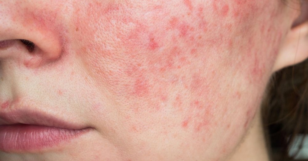 Rosacea: Kompletná rutina starostlivosti o pleť