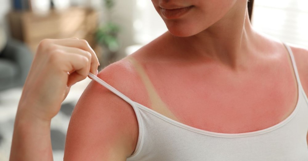 How to (not) get burned on holiday: The summer mistake we all make