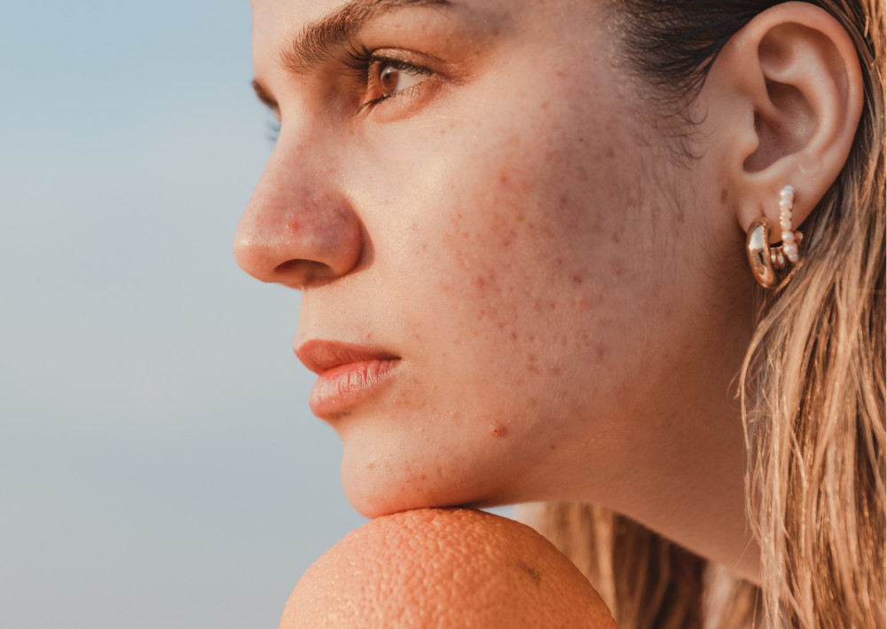How to effectively care for scars (not just) from acne