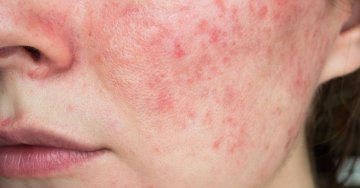 Rosacea: Kompletní rutina péče o pleť