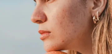 Rose in der Kosmetik: Zu Akne neigende Haut