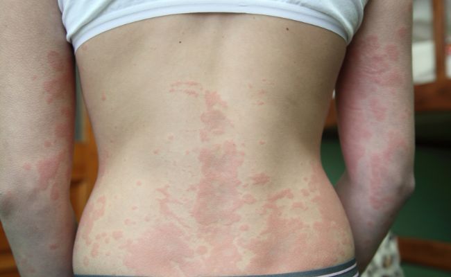 Kapitola 1: Porozumenie atopickému ekzému